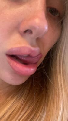 Josie adora enchimento de lábios e vender no snap